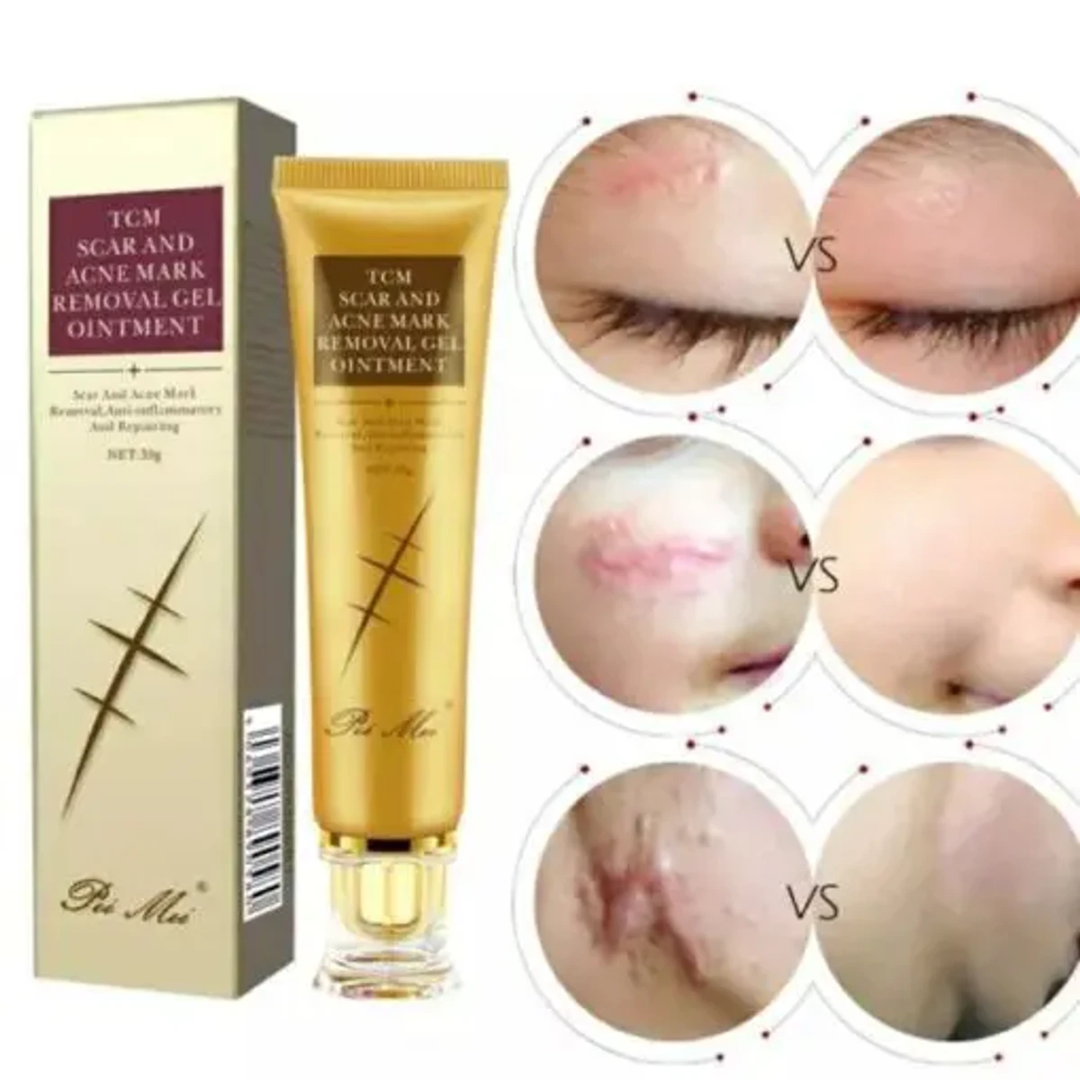 Acne Scar Removal Treatment Cream